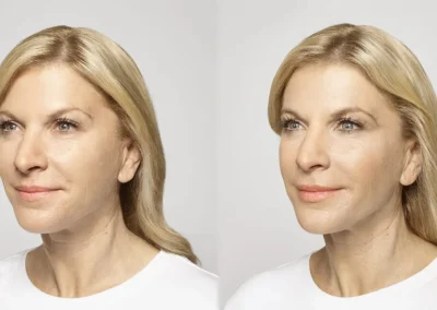 4 5 1 restylane before and after photos by glow medical aesthetics in houston tx