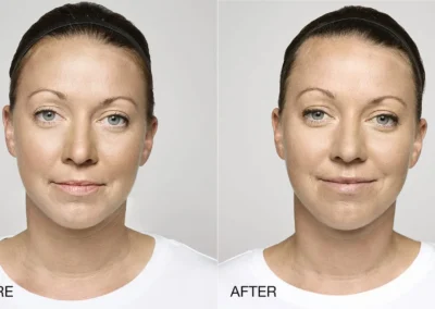 4 6 1 restylane before and after photos by glow medical aesthetics in houston tx