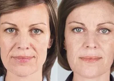 5 2 1 sculptra before and after photos by glow medical aesthetics in houston tx