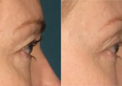8 2 1 ultherapy before and after photos by glow medical aesthetics in houston tx