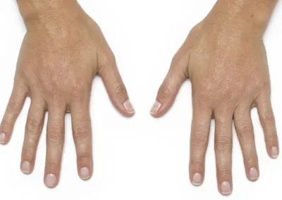 9 2 1 hand rejuvenation before and after photos by glow medical aesthetics in houston tx