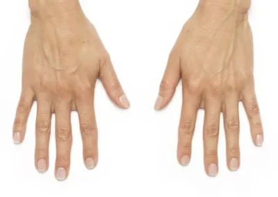 9 3 1 hand rejuvenation before and after photos by glow medical aesthetics in houston tx